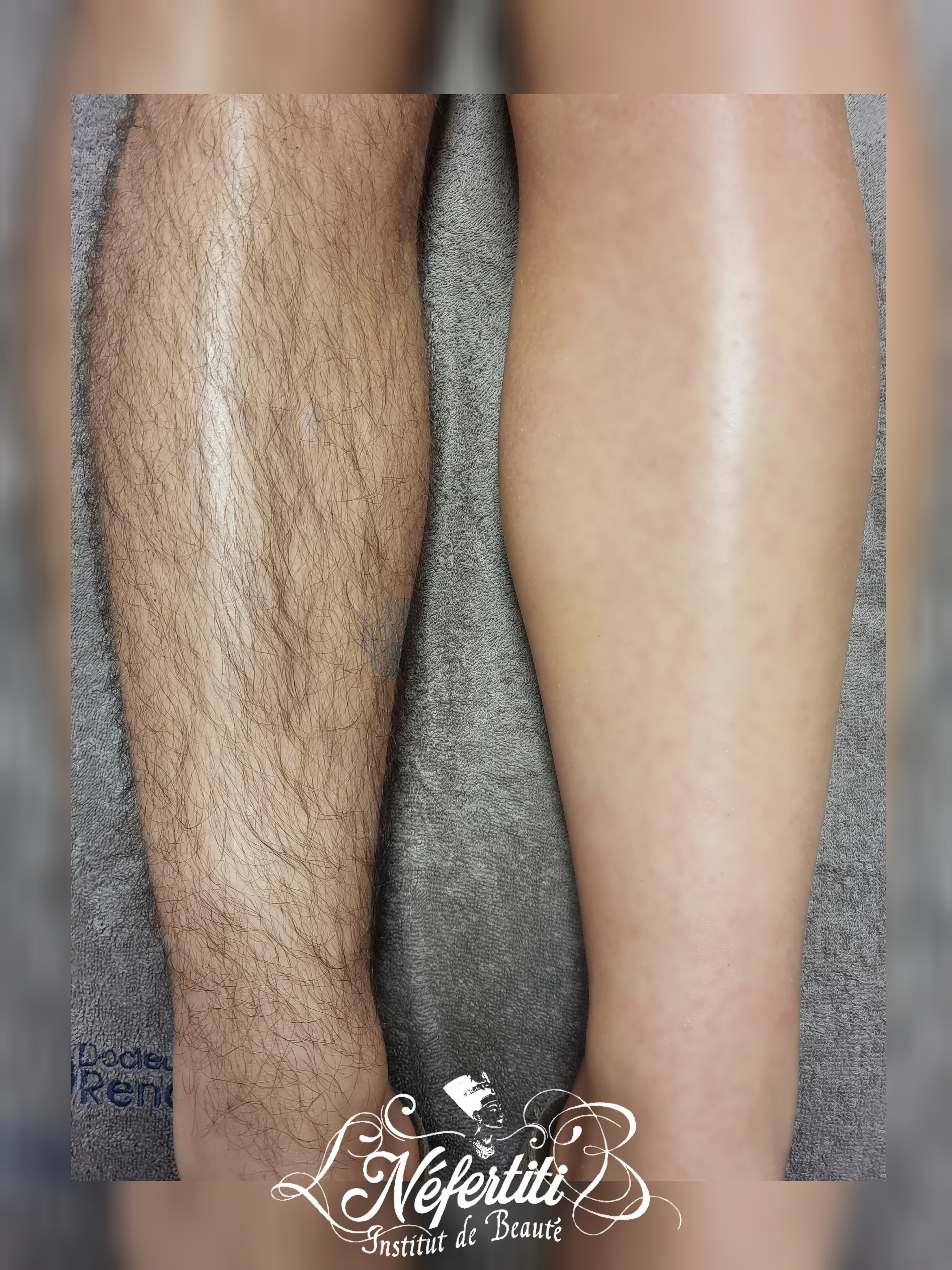 Photo de la catégorie EPILATION HOMME