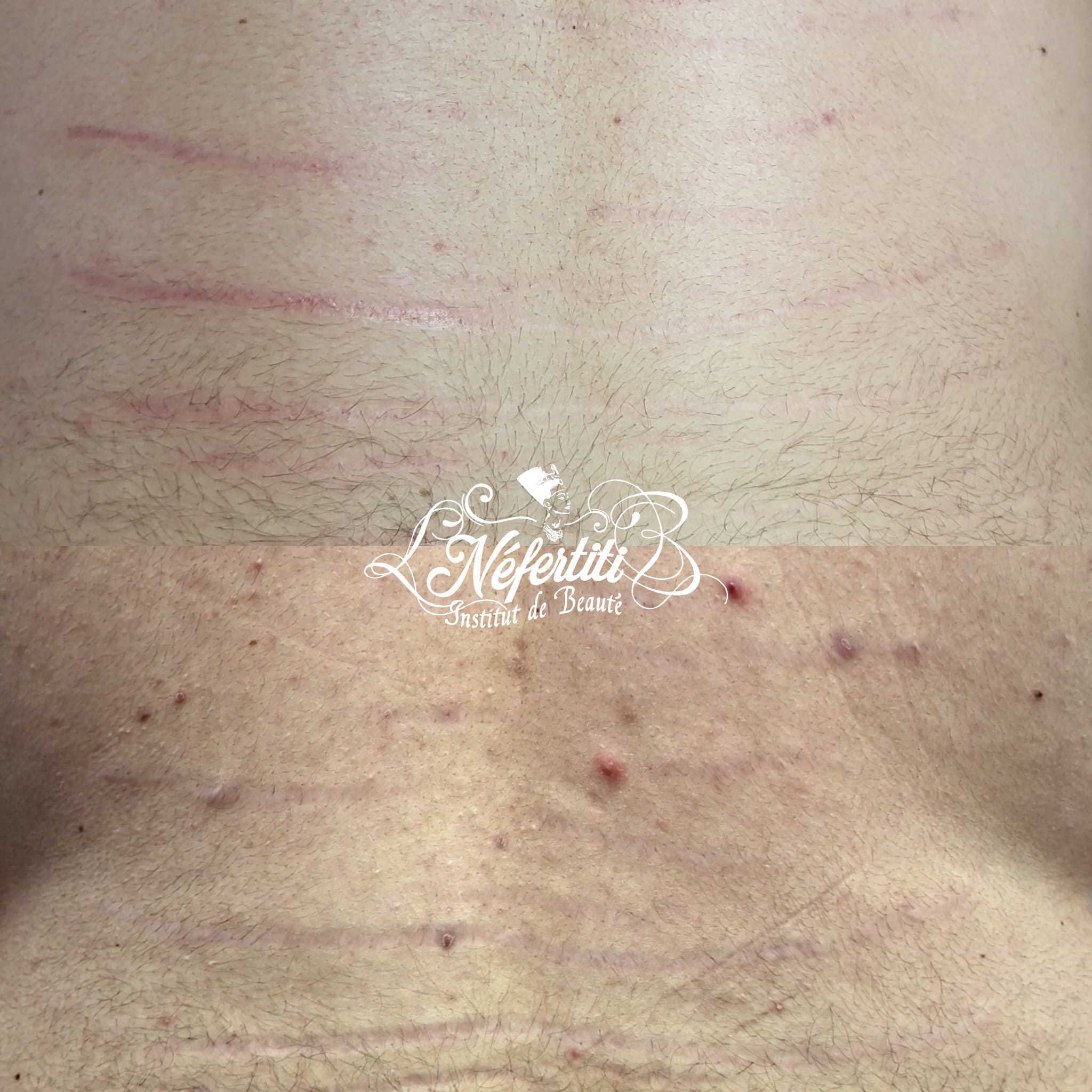 Vergetures dos